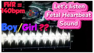 Baby heartbeat sound on ultrasound  heart rate boygirl  Fetal doppler heartbeat sound [upl. by Holder]