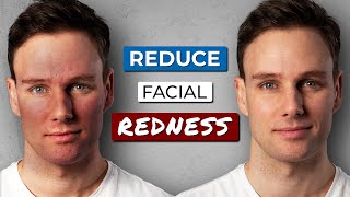 How to GET RID OF REDNESS on your FACE [upl. by Sharla69]