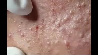 whiteheads removal  blackheads removing  blackhead removal nose 2019 [upl. by Aivatnuhs87]