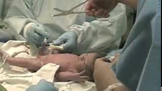 Twins Birth by Cesarean nongraphic  emergency delivery of multiples attended by doula [upl. by Anama]