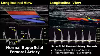 Femoral Artery Doppler Ultrasound Normal Vs Abnormal  StenosisOcclusionPseudoaneurysmAVF USG [upl. by Barkley311]