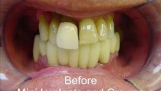 Mini Dental Implants  Before and After [upl. by Lally]