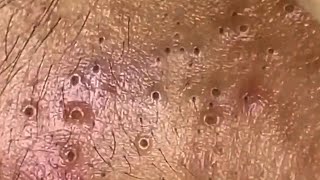 Blackheads amp Whiteheads Satisfying Removal 0014 [upl. by Roose877]