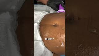 Body Sculpting Tip Lipo Cavitation Technique [upl. by Parrie]