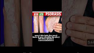 psoriasis treatment in Hindi [upl. by Ann754]