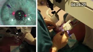 Realtime uncut unedited LASIK procedure live with real sound [upl. by Anicul]