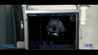 Chison EBit 50 Biometría fetal  Ultrasonido HK [upl. by Lihp225]