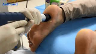 shockwave therapy machine operation video [upl. by Bernhard964]