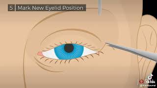 Procedural Steps for Lateral Tarsal Strip Procedure for Left Lower Eyelid Entropion [upl. by Ardehs]