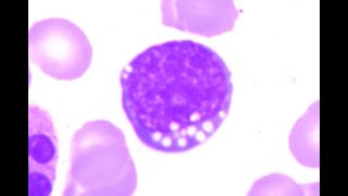 Vacuolated and basophilic blasts of Burkitt Lymphoma [upl. by Allemac]