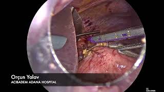 Laparoscopic Proximal Gastrectomy with Double Tract Anastomosis [upl. by Anitsenre]