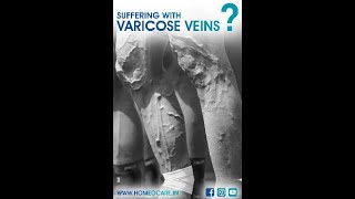 Homeopathy Treatment for Varicose Veins  Homeocare International [upl. by Bobbie]