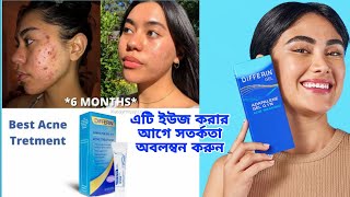 রাতারাতি ব্রন দূর করার জেল কতটা কার্যকরী Differin Gel Acne Treatment  khadija begum [upl. by Krys]