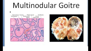 Pathology 810 a Goitre thyroid Multinodular adenomatous Plummer syndrome toxic [upl. by Attenauq]