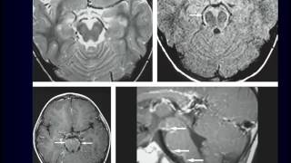 pyogenic CNS infection [upl. by Odlaner]