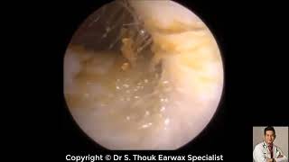 Top Biggest Ear Wax Removal 102 Ear wax Extraction Dr S Thouk Earwax Specialist [upl. by Joed]