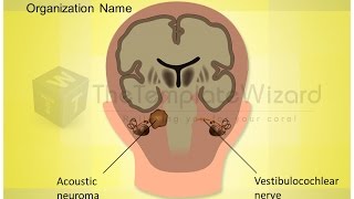 Acoustic Neuroma Vestibulocochlear Nerve Medical PPT Presentation Template by TheTemplateWizardcom [upl. by Eillat]