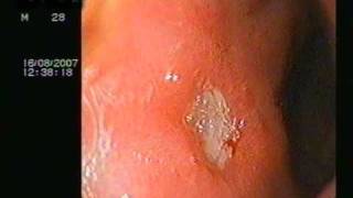 DUODENAL ULCER ON ENDOSCOPY [upl. by Briscoe806]