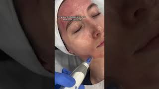 Facial Rejuvenation with MicroNeedling  Dr MediSpa [upl. by Tenner505]