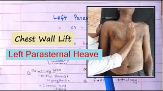 Clinical Sign Of Right Ventricular Hypertrophy  Left Parasternal Heave How To Palpate [upl. by Elumas915]