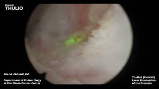 Dr Eric Ghiraldi Thulio® TmYAG Laser Enucleation of the Prostate [upl. by Renie]