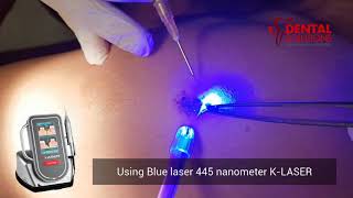 Wart removal using laser [upl. by Worsham]