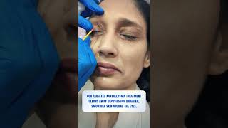 Xanthelasma Treatment  Skin Clinic  Kolkata  Skin Treatment  youtubereels youtubeshorts [upl. by Ano21]