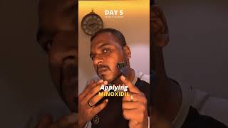 Using Minoxidil daily for Hair Growth  Day 5 minoxidil bald microneedling dermaroller hairloss [upl. by Vito]