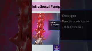 Intrathecal Pump Drug delivery shorts [upl. by Werdn]