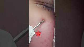 Spider Angioma Treatment l Spider Naevus l Spider Telangiectasia Learning of Doctors [upl. by Errised]