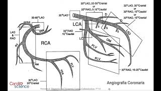 ANGIOGRAFIA CORONARIA OPTIMA Y MATERIALES EN INTERVENCIONISMO HD 720p [upl. by Ready301]