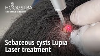 Sebaceous cysts Lupia  Laser treatment  24098 [upl. by Fidole]