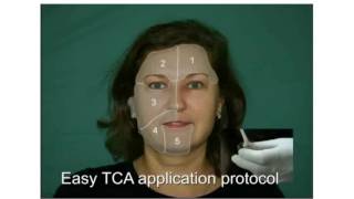 Skin Tech guide for patients Easy TCA treatment [upl. by Arremat394]