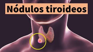 NÓDULOS TIROIDEOS síntomas diagnóstico tratamiento y prevención bulto o bola en el cuello [upl. by Ulrike]