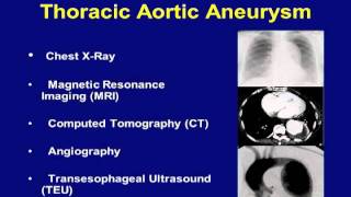 Minimally Invasive Repair of Thoracic Aortic Aneurysm Video  Brigham and Womens Hospital [upl. by Ahseenat]