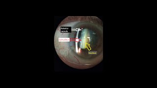 Slit lamp cataract assessment [upl. by Benge]