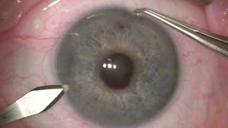 Cataracta Complicata in Chronic Uveitis Seclusio Pupillae Synechiolyses [upl. by Akerue]