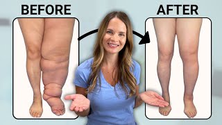 The Best Treatment for Lymphedema [upl. by Raymonds]