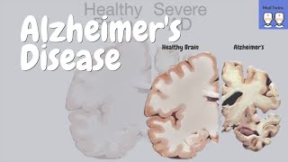 Alzheimers disease Pathophysiology Amyloid plaques and Tau tangles Risk Factors Treatment [upl. by Notrem]