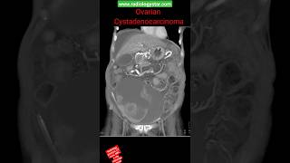 Ovarian Cystadenocarcinoma shorts radiology youtubeshorts [upl. by Airtemak]