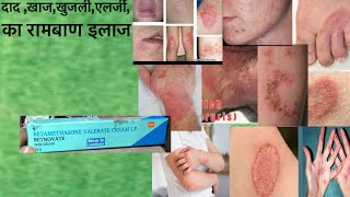 Betnovate cream Full Information In Hindi  Uses  Side effects  Dosage [upl. by Nwahsek]