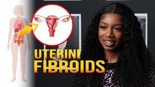 Uterine Fibroids Complications  MarieCatherine Kodjo [upl. by Paxon]