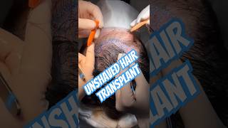 Another 1026 Graft Real Long Hair Transplant Day 100 Long Hair longhair hairtransplant asmed [upl. by Kendricks703]