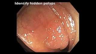 Ascending colon  cap identified hidden polyp [upl. by Chassin805]