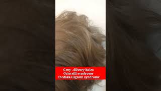 Griscelli syndrome  Chediak higashi syndrome HLH  Grey silvery in hairs kidsTests and treatment [upl. by Aniral]