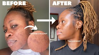 THEY SAID MY SKIN WOULD NEVER CLEAR AND I PROVED THEM WRONG My morning acne skincare routine [upl. by Shirlee]