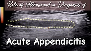 Ultrasound Acute Appendicitis  How to Prevent from False ve Diagnosis in Initial Stage [upl. by Supat]