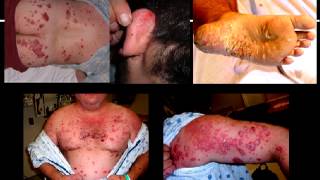 Stelara Side Effects  Stelara causes drug induced psoriasis  Biologic problems [upl. by Nnayram]