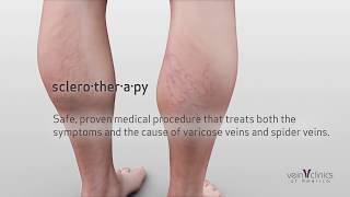 What is sclerotherapy treatment  Vein Clinics of America [upl. by Enelyahs]