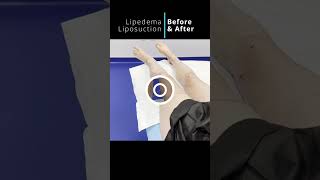 Amazing Lipedema Leg Lipo shorts artlipo liposuction weightloss beforeandafter [upl. by Kcyrred846]